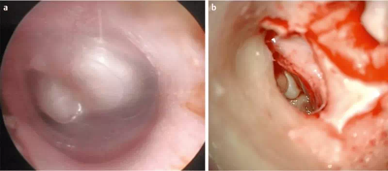 کلستئاتوم یا تومور گوش میانی